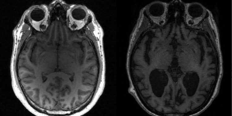 Cientistas descobrem os motivos do avanço do Alzheimer no cérebro