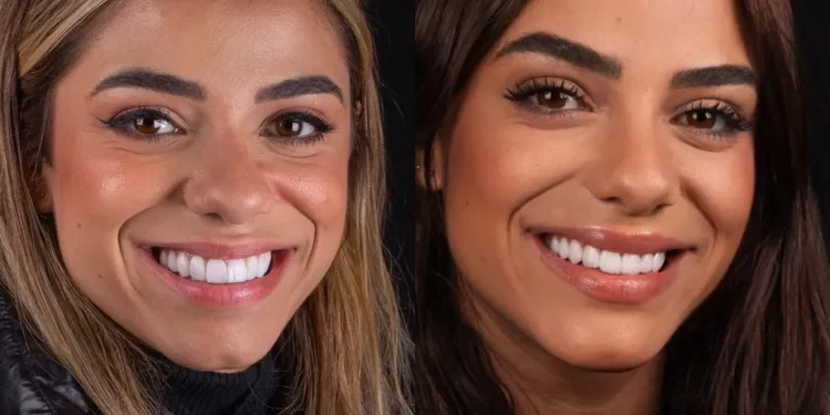 Key Alves gasta R mil para mudar as lentes de porcelana – Veja antes e depois Key Alves gasta R mil para mudar as lentes de porcelana – Veja antes e depois