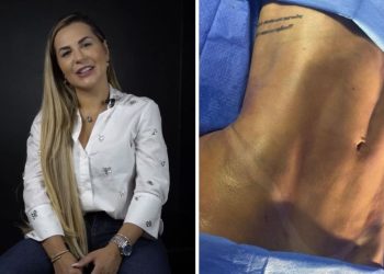 Veja o resultado da lipo LAD realizada em menos de um mês por Deolane Bezerra