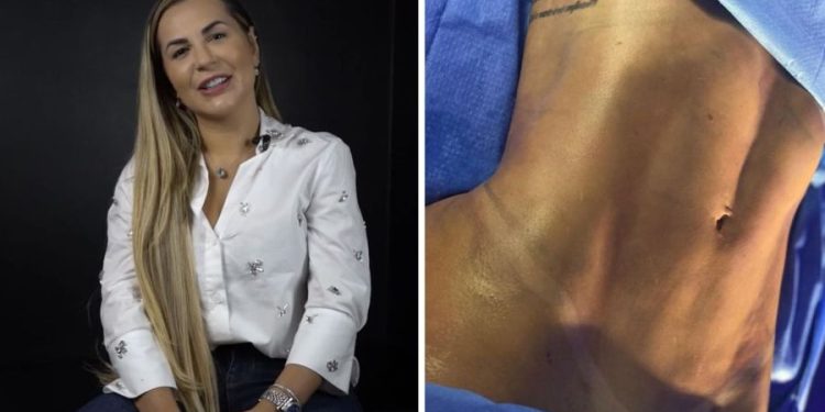 Veja o resultado da lipo LAD realizada em menos de um mês por Deolane Bezerra Veja o resultado da lipo LAD realizada em menos de um mês por Deolane Bezerra