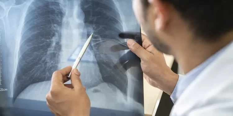 Anvisa aprova Emrelis, novo medicamento para câncer de pulmão avançado Anvisa aprova Emrelis, novo medicamento para câncer de pulmão avançado